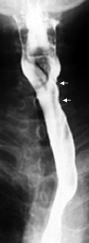 Figure 2.  Barium contrast esophagograms 1 year after the radiotherapy showing a slight deformity of the wall in only the upper portion of the cervical esophagus (arrow), but no tumor.