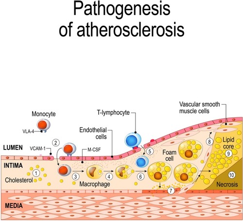 Figure 4 Schematic of atherogenesis. Explanation in the text. ©[designua]/123RF.COM.