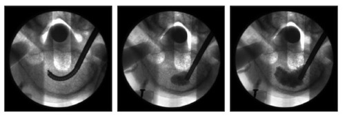 Figure 3 Stepwise unipedicular radiofrequency-targeted vertebral augmentation procedure including controlled intravertebral cavity creation with MidLine Osteotome (DFINE, Inc, San Jose, CA) (left), targeted delivery of StabiliT® ER2 (DFINE) ultrahigh-viscosity polymethylmethacrylate beginning anteriorly (middle), and continued delivery of polymethylmethacrylate with trabecular interdigitation and controlled vertebral height restoration (right).