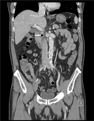 Figure 2 Abdominal CT showing decreased loculated fluid collection with air bubbles (white arrow) around duodenal second portion.