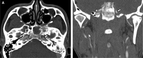 Figure 3 Emergent computed tomography angiography of the neck, including the base of the skull.