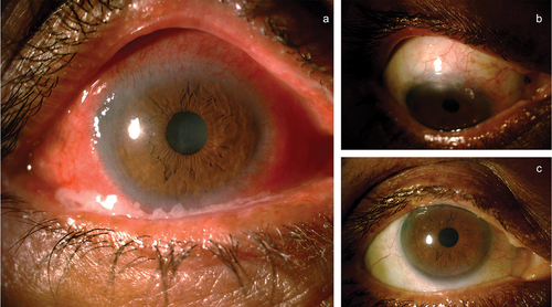 Figure 5. (a) A patient with antiglaucoma medication toxicity showing conjunctival congestion, discharge, and peripheral corneal vascularization, (b and c) Showing quiet eyes of the same patient with quiet ocular surface post combined cataract and trabeculectomy surgery and stopping all topical medications.