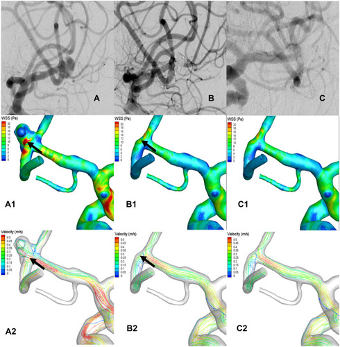 Figure 3 Representative images of a non-recurrent middle cerebral artery bifurcation aneurysm (MCABA). (A–C) The DSA images were acquired from a 56-year-old woman with a left MCABA. (A) Preoperative DSA revealing a left MCABA. (B) Immediately after the operation, DSA showed the degree of aneurysm embolization reached the standard of Raymond I. (C) The follow-up DSA after 4 months showed that the aneurysm was non-recurrent. (A1, A2) The hemodynamic analysis preoperatively of the left MCABA. (B1, B2) The hemodynamic analysis immediately postoperatively of the non-recurrent MCABA. (C1, C2) The hemodynamic analysis at follow-up of the non-recurrent MCABA. (A1, B1, C1) MWSS (T = 0.2 s). (A2, B2, C2) Flow velocity (T = 0.2 s). The blood-flow pattern of the non-recurrent MCABA preoperatively was the same as the recurrent MCABA; however, the MWSS and flow velocity at the aneurysmal neck immediately postoperatively were remarkably lower than those preoperatively (Black arrow showed, T = 0.2 s).