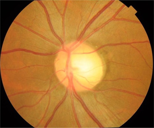 Figure 1 Funduscopy showed the temporal disc pallor in the left eye.