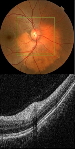 Figure 22 The B-scan line on the fundus photograph (top) has the same width as the B-scan SD-OCT image (bottom) demonstrating the appearance of osseous choristoma.