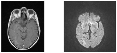 Figure 1 Cranial T1-weighted magnetic resonance imaging at the end of September 2010 revealed nodular contrast enhancement with subcortical diffuse restriction in the right parieto-occipital region which is not typical for multiple sclerosis.