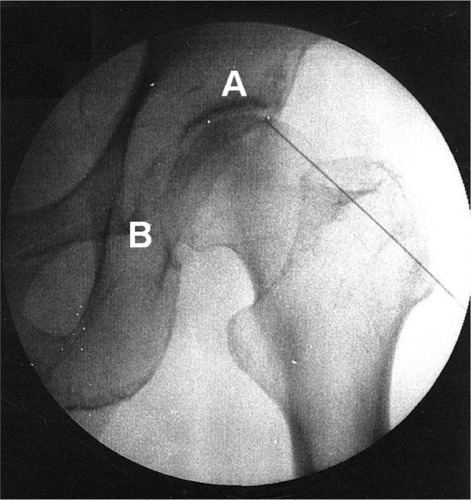 Figure 1 Fluoroscopic image showing radiofrequency cannula toward the articular branches of the femoral nerve (A) and the obturator nerve (B).