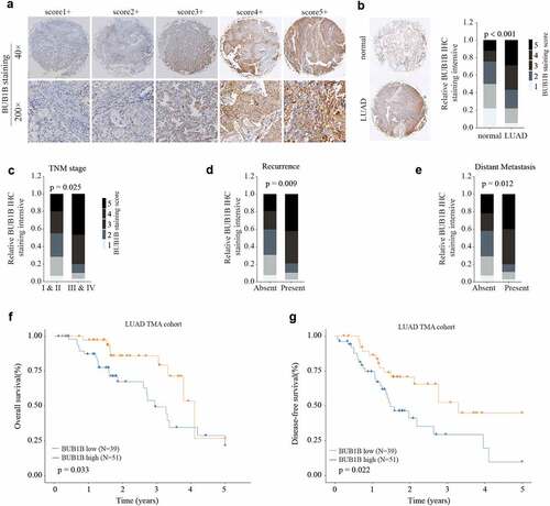 Figure 2. BUB1B is significantly increased in LUAD tissue and predicts poor outcome in LUAD patients. (a) Representative BUB1B IHC staining with different BUB1B staining scores in LUAD. (b) Representative BUB1B IHC staining in LUAD tissues and adjacent non-tumor normal tissues (left) and comparison of IHC staining score distributions between them (right). (c, d, e)Representative BUB1B IHC staining in LUAD tissues with different TNM stages(c), absence or presence of recurrence(d), and absence or presence of distant metastasis(e). (f, g) Kaplan-Meier analysis of OS(f) and DFS (g) in LUAD patients with low or high BUB1B expression.