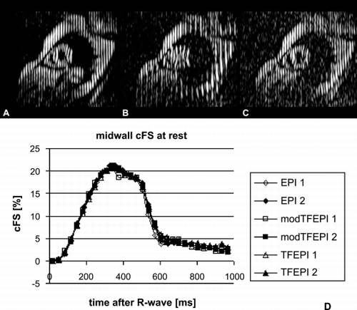 Figure 1. CSPAMM images acquired with EPI (A), TFEPI (B) and modified TFEPI (C) and corresponding midwall cFS‐time curves (D).