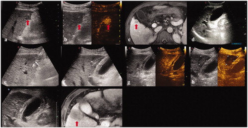 Figure 3. A 45-year-old male. (a, b, c). Contrast-enhanced ultrasound and MRI indicated a liver tumor located in segment 5 adjacent to the gallbladder with a maximum diameter of 18 mm. (d) Before ablation, the thickness of gallbladder wall was 5 mm. (e) The electrode was inserted parallel to the gallbladder wall with a minimum distance of 6 mm. (f) The thickness of gallbladder wall increased to 10 mm immediately after ablation. (g, h). Contrast-enhanced ultrasound showed that the perfusion of gallbladder wall was intact and the index tumor had been completely ablated. (i) The thickness of gallbladder wall was 9 mm five days after ablation. (j) Contrast-enhanced MRI one month after the ablation procedure confirmed the technical efficacy and the thickness of gallbladder wall was restored to 5 mm.