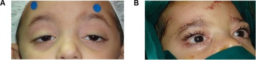 Figure 1 Preoperative (A) and at the conclusion (B) of fascia lata sling surgery.