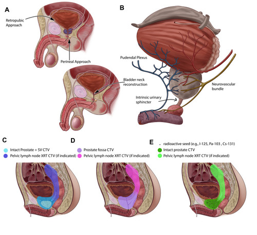 Figure 1 Surgical and Radiotherapeutic Approaches in the Treatment of Prostate Cancer. (A) pre- and post-prostatectomy anatomy with retropubic and perineal surgical approaches. (B) microsurgical anatomy at risk for injury with retropubic and surgical approaches. (C) clinical target volumes (CTV) for radiotherapy for intact prostate treated definitively with external beam radiotherapy (XRT). When indicated pelvic lymph node fields are added, increasing the potential for gastrointestinal toxicity. (D) CTV for radiotherapy for prostate fossa treated adjuvantly or in salvage cases. The utility of lymph node coverage in this setting is the subject of clinical investigation. (E) CTV for low-dose-rate brachytherapy with or without XRT treatment. High-dose-rate techniques are available using temporary catheter-based placement of an Ir-192 source with established fractionation schedules and fewer post-treatment radiation precautions.
