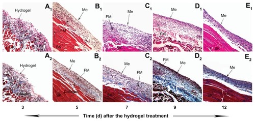 Figure 7 The fibrosis and the remesothelialization of the peritoneal wounds treated with PECE hydrogel. Three days after the treatment, a coating of the hydrogel on the injured surface of the abdominal wall, with infiltration of inflammatory cells (A1, 200×) and scattered collagen beneath (A2, 200×). Five days after the treatment, the layer of inflammatory cells composed mainly of foamy macrophages appeared, above which was a layer of spindle-shaped mesothelial cells (B1, 200×), and under which was a collagen layer (B2, 200×). Along with days, collagen- and fibroblast-rich tissues gradually increased and replaced the structure of the inflammatory cell layer (C1, C2, D1, D2, E1, E2, 200×).Abbreviations: Me, mesothelial cell layer; SK, skeletal muscle; FM, foamy macrophages; PECE, poly (ethylene glycol)-poly (ɛ-caprolactone)-poly (ethylene glycol) (PEG-PCL-PEG).