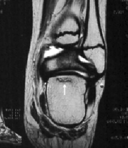 FIGURE 1 Osteonecrosis of the astragalus after induction chemotherapy treatment.