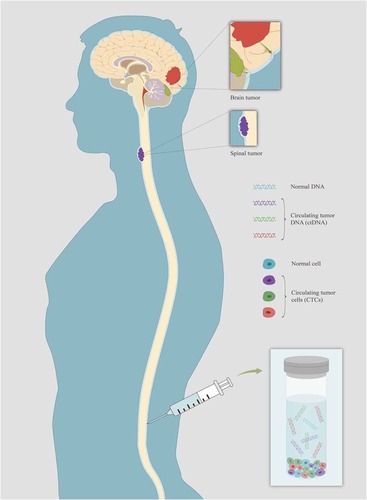 Figure 1 Schematic showing the source of CSF-ctDNA and CTCs from primary and metastatic CNS tumors. CSF serve as a “liquid biopsy” of CNS malignancies for evaluating ctDNA to characterize tumor-specific mutations.