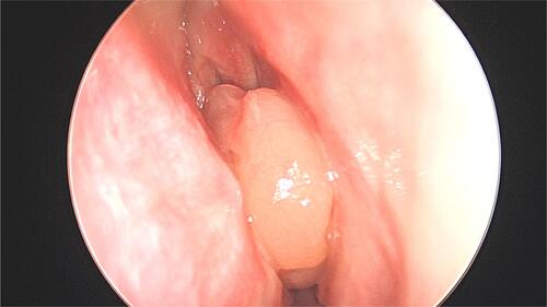 Figure 1 Intraoperative endoscopic image of a nasal polyp. Photo courtesy from Alissa Kanaan.