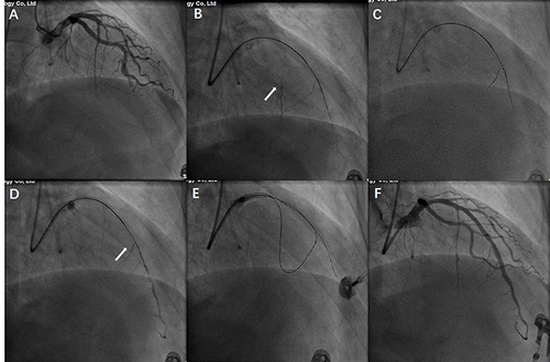 Figure 1 Angiogram of an LAD CTO of a 45-year-old male patient with ischemia symptoms (A). Tip injection via a Finecross microcatheter facilitated the visualization of septal channels (B). (C) The Sion guidewire successfully crossed the septal pathways into the distal LAD segment. Tip injection again helped to ensure the distal true course (D). The Gaia 2 guidewire crossed the occlusion via a retrograde approach (E). (F) Final angiogram after stent implantation, in which the vessel hematoma could be found in the mid-LAD.