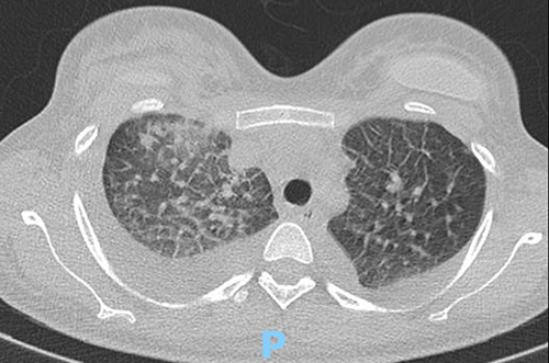 Figure 4 Contrast-enhanced chest computed tomography illustrating “crazy paving” pattern in the right lower lobe of the lung and bilateral pleural effusions.