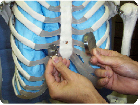 Figure 1. Implanted component of the magnetic pectus excavatum device, which is transfixed to the sternum via a small incision.