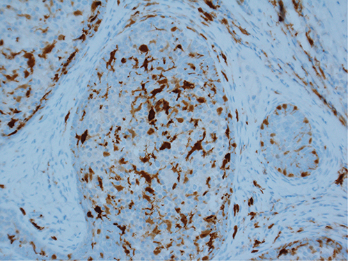 Figure 9 S-100-positive staining of many intralobular dendritic cells. (Magnification ×200).