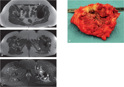 Figure 3. Images from a 43-year-old woman who had undergone total hip arthroplasty of the left hip 2.5 years earlier. Her replaced hip made clacking sounds, and she also had intense pain in both the groin and in the trochanteric region during exercise—and even at rest. Whole-blood cobalt was 8.8 ppb and chromium was 3.1 ppb (normal reference values are < 0.8 ppb for Co and Cr). A. Axial T1 view of a thick-walled partly cystic large pseudotumor mass extending from the iliopsoas region to the posterolateral region. The posterolateral part of the pseudotumor appeared mostly solid with variable signal intensity in T1 (panel B) and STIR (C). A predominantly solid pseudotumor was encountered in revision surgery (D).