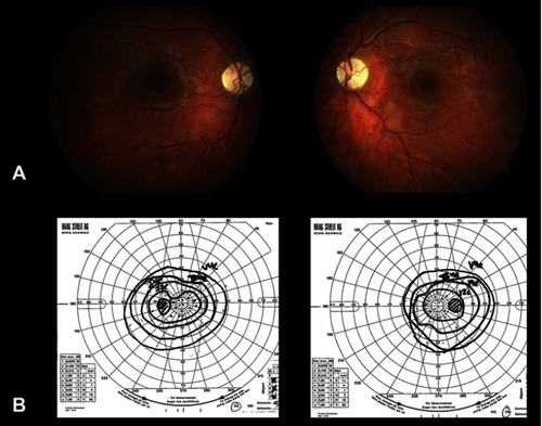 Figure 4 Fundus photos (A) and Goldmann visual fields (B) in a patient with tuberous sclerosis complex who had been on vigabatrin for over 10 years. On fundus photos, there is bilateral optic atrophy and diffuse loss of retinal nerve fiber layer. There is also a retinal astrocytic hamartoma in the left eye along the inferior temporal arcade. Corresponding visual fields show concentric constriction of peripheral visual fields in both eyes.
