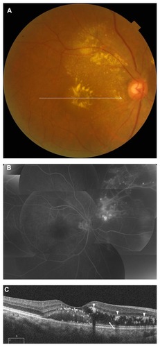 Figure 2 A 72-year-old woman (patient 8) with a branch retinal vein occlusion had a 2-month history of blurred vision in her right eye. Best-corrected visual acuity was 0.15. (A) Fundus photograph shows serous macular detachment and hard exudates. The horizontal arrow indicates optical coherence tomography scanning lines (6 mm). (B) Fluorescein angiogram reveals dye leakage from retinal vessels and a large area of capillary nonperfusion extending from the optic disk to the superonasal mid peripheral fundus but no dye leakage in the macular area. (C) A horizontal optical coherence tomography scan shows a serous retinal detachment at the fovea and outer retinal swelling, which is evident nasal to the fovea (arrow) and hard exudates (arrow heads).