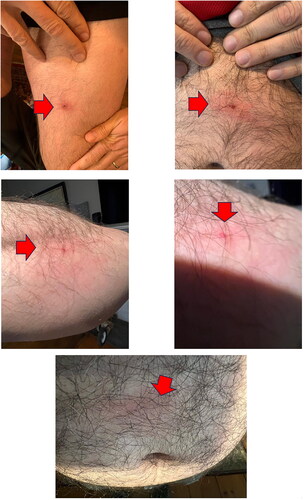 Figure 2. Skin reactions to different deer tick bites in case 2. Photos courtesy of participants in case 2.
