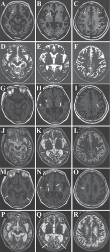 Figure 2 Serial changes of the brain magnetic resonance imaging (MRI) (A–F, February, 2000; G–L, May, 2004; M–R, November, 2007). In 2000, scattered high intensity lesions were confirmed both in the caudate (B, arrow) and cerebral cortex (A and C, arrowheads) by T1-weighed image, though T2-weighed images (D–F) revealed no definite abnormalities. In 2004, the cerebral sulci became wider (H, arrowheads, and I, arrow) and the ventricles became larger (H, arrows). T2-weighed image showed high intensity lesions in the subcortical white matter (L, arrow). The brain became further atrophic in 2007, with widening of cerebral sulci (N, arrowheads) and dilatation of ventricles (M, N, and O, arrows). High intensity lesions were confirmed in the subcortical white matter of the occipital (Q, arrows) and parietal (R, arrows) lobes.