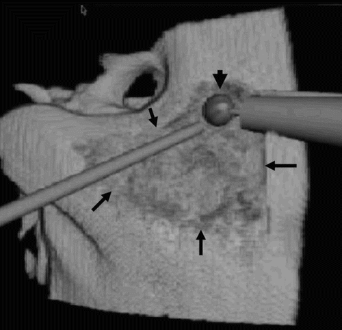 Figure 4. Triangular surgical cavitation of the mastoid (arrows) is used to remove the mastoid air cells and reach the mastoid antrum. The drill burr (arrowhead) is creating access to the tympanic cavity.