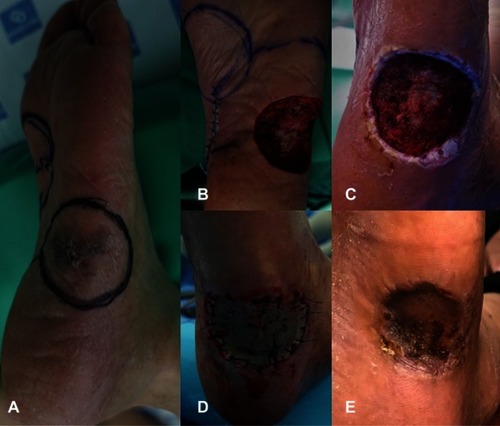 Figure 2 A 69-year-old male presented with color change in the left foot 4 months ago. (A) A 3×2 cm pigmented skin lesion was observed on the lateral side of the mid-plantar foot. (B) Wide excision with a margin of 1 cm or more was performed, and plantar fascia was exposed through skin defect. (C) One week after surgery, a dermal matrix was formed. (D) Split-thickness skin graft was performed by harvesting from the ipsilateral thigh. (E) Six weeks after the surgery, complete healing of the skin graft was confirmed.