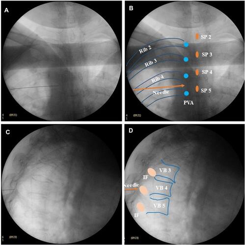 Figure 3 Location of the needle tip under fluoroscopy. (A) The needle tip was located at the lateral edge of the pedicle in the AP view of fluoroscopy. (B) Schematic diagram of the location of the needle tip (brown) in the AP view on fluoroscopy. (C) The needle tip was located in the external space of the intervertebral foramen in the lateral view on fluoroscopy. (D) Schematic diagram of the location of the needle tip (brown) in the lateral view on fluoroscopy.