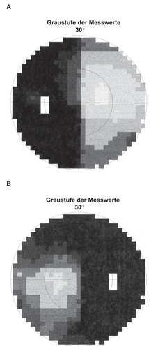 Figure 1 The preoperative visual field. A) Left eye. B) Right eye.