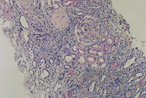 Figure 1.  Light microscopic appearance of a renal biopsy demonstrated focal and segmental solidification of glomerular tuft, agglutination of capillaries with hyaline deposits. There is also interstitial infiltrate. H&E × 100.