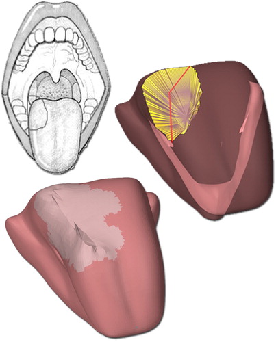 Figure 9. From top to bottom: preoperative drawing of the surgical area, selected resection volume on the preoperative model and the post-operative model. The grey area on the post-operative model is the visual representation of scar tissue.