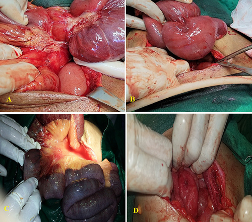 Figure 1 Intraoperative photos showing: (A) Small bowel tumor with adhesion in a 55-year-old male who underwent resection and anastomosis. (B) adhesion in a 30-year-old male who underwent adhesiolysis. (C) Mesenteric ischemia in a 62-year-old male due to superior mesenteric thrombosis that underwent open and closed surgery. (D) Tuberculosis in a 21-year-old female who underwent a biopsy.