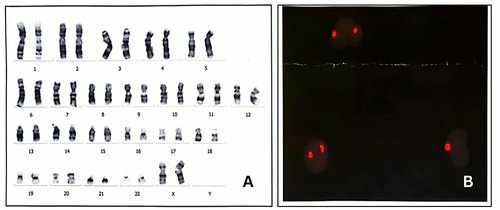 Figure 3 Patient’s chromosomal analysis. (A) Patient’s chromosome was 46XX; (B) FISH analysis reveals X mosaicism with no Y chromosome (X probe: red; Y probe: green).