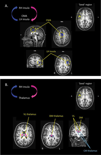 Figure 7. (A) Results of the effective connectivity analyses, based upon Granger causality mapping (GCM), of the yawning fMRI study. In this case, the “seed” region for the GCM has been defined as the region of the insular cortex of the right hemisphere that was significantly activated during the urge to yawn. The GCM analysis revealed that corresponding regions of the insular cortex within the left hemisphere, and the mid-cingulate cortex bilaterally, each exert a significant influence over the seed region (blue). CMA: cingulate motor area; TRA: transverse. (B) Further results of the GCM analysis based upon the right insula “seed” region. The analysis also revealed that regions of the centromedial thalamus bilaterally exert a significant influence over the seed region (blue), and that bilateral regions of the ventral-lateral and dorsomedial thalamus are influenced by the seed area (pink).