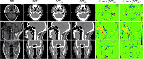 Figure 2. The MR, the PCT, the SCT images, and the HU error distributions for a test patient with average HU accuracy.