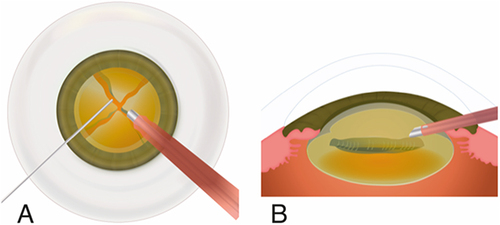 Figure 1 (A) Nucleus disassembly is achieved by sculpting grooves with the phaco probe and cracking the lens into four quadrants. After the nucleus is divided into two, the second instrument spins the lens 90 degrees, suitably placing the lens to create the subsequent groove. (B) Groove carving lateral view. The groove must ideally be at least 1.5 times as wide as the phaco-tip to facilitate adequate nucleus disassembly.