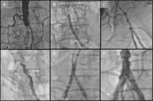 Figure 2 Transradial approach to Leriche’s syndrome. A) Aortogram showing distal aorta total occlusion. B) Balloon angioplasty of left common iliac artery (CIA) following successful wire crossing. C) Catheter-directed thrombolysis of left CIA. D) Left CIA opacification following overnight infusion of tPA. E) Kissing balloon inflation of bilateral CIA. F) Successful restoration of inflow.