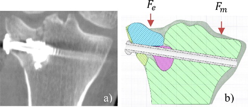 Figure 1. a) Coronal CT Scan view of the tibia after stabilization. b) Schematic representation of the geometry, red arrows indicate the load.