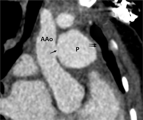 Figure 4 Sagittal contrast-enhanced CT image displaying the ascending aortic pseudoaneurysm with intraluminal thrombus formation. Single arrow: rupture site; Double arrows: mural thrombus.