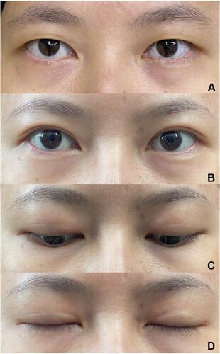 Figure 6 Patient 3. (A) Preoperative view of a 25-year-old female who underwent double-eyelid blepharoplasty with TOS fixation. Postoperative views at eighteenth month with her eyes open (B), eyes gazing downward (C), and eyes closed (D).