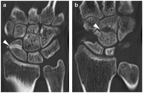 Figure 3. Computed tomography (CT) scan of the hand. Sagittal CT image of bone separation with osteosclerosis in the distal part of the scaphoid bone (a), and a radiolucent line in the central area of the capitate bone (b).