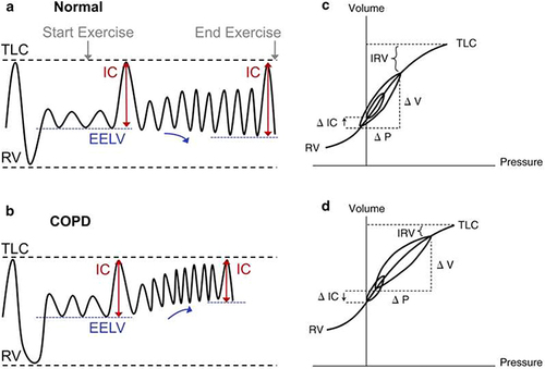 Figure 1 Rest and exercise spirograms, and placement of rest and exercise tidal breaths on the respiratory system compliance (Pressure – Volume) curve for a healthy individual (a and c) and an individual with chronic obstructive pulmonary disease (COPD) (b and d). End expiratory lung volume (EELV) decreases in the healthy individual during exercise, but increases in COPD, as reflected in increase, and decrease of inspiratory capacity (IC), respectively. The position of VT increases closer to total lung capacity (TLC) for the patient with COPD on the pressure volume curve (c, d) resulting in both a greater reduction in inspiratory reserve volume (IRV) and a larger ventilatory pressure (ΔP) requirement for a given change in volume (ΔV). RV, residual volume. Reprinted with permission of the American Thoracic Society. Copyright © 2023 American Thoracic Society. All rights reserved. O’Donnell DE. Hyperinflation, dyspnea, and exercise intolerance in chronic obstructive pulmonary disease. Proc Am Thorac Soc. 2006;3(2):180–184. The American Journal of Respiratory and Critical Care Medicine is an official journal of the American Thoracic Society.Citation7