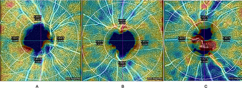 Figure 2 OCTA results in healthy (A), glaucoma suspected (B), and glaucomatous eyes (C).