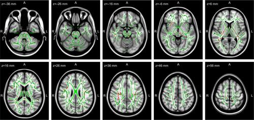 Figure S1 TBSS results of the FA images between the controls and CID patients. Green represents the mean FA skeleton of all participants; red represents the regions with decreased FA in the CID patients (P<0.05, without correction for multiple comparisons).Abbreviations: TBSS, tract-based spatial statistics; CID, chronic insomnia disorder; FA, fractional anisotropy.