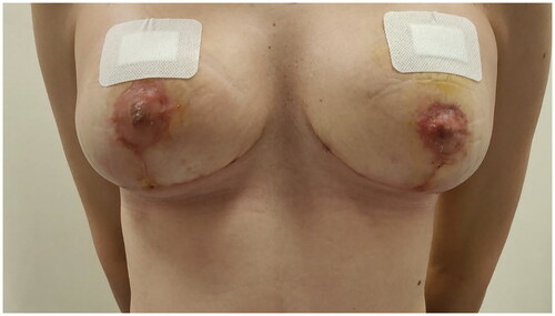 Figure 4. Patient one-month post-mastectomy surgery and placement of tissue expanders.
