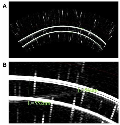 Figure 1 B-scan reconstruction, as obtained from the HF UBM system showing epithelium and corneal thickness measurements via the caliper tool. We observe the anterior and posterior cornea, as well as the cornea–epithelium interface. (A) Full scan, scale 8.4 μm/pixel. (B) Detail.